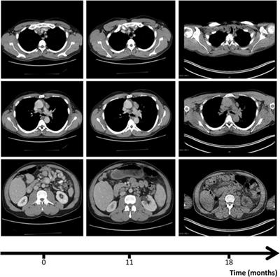 First Association of Interleukin 12 Receptor Beta 1 Deficiency with Sjögren’s Syndrome